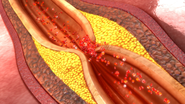 Атеросклероз брюшной аорты — что это такое: симптомы и лечение, диета Здоровье