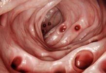 Diverticulosis: la afección intestinal común que la mayoría de las personas desarrolla a los 80 años