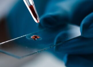 Bloedonderzoek voorspelt het risico op dementie bij vrouwen, jaren vóór de symptomen